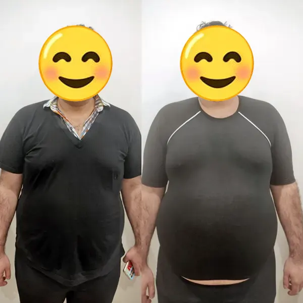 قبل و بعد کاهش چربی شکم