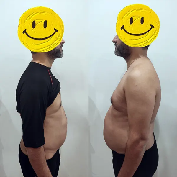 قبل و بعد لاغری پهلو