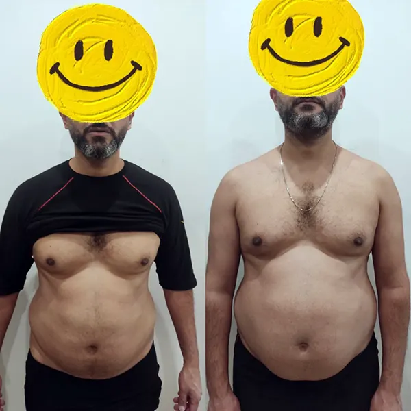 حذف چربی‌های اضافه بدن