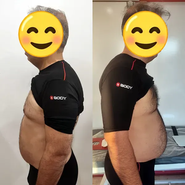 لاغری موضعی با نتیجه قطعی