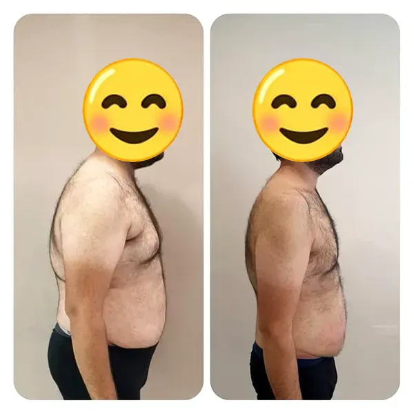 قبل و بعد کاهش سایز شکم